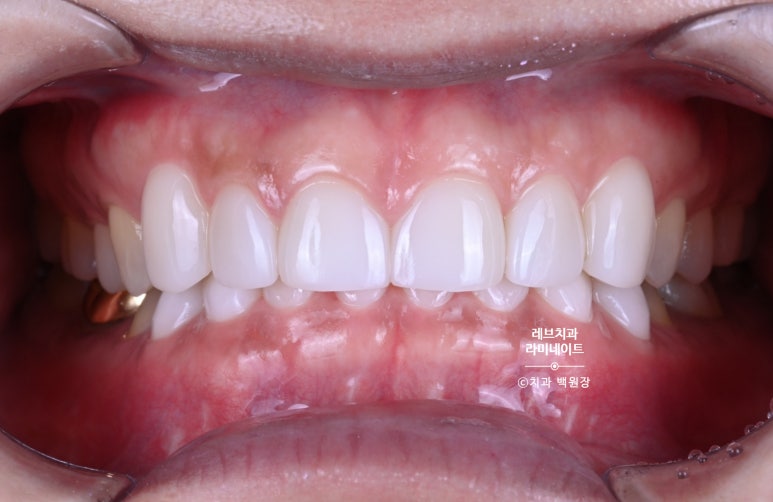 아래앞니 라미네이트도 무삭제로 가능한가요? 레브네이트 베이직 가격/비용/후기/추천. 관련 이미지 11