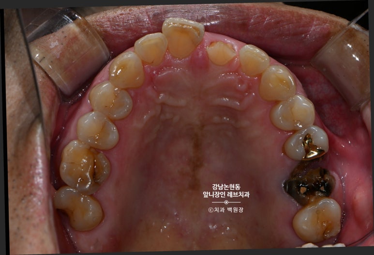 강남논현동치과 60대 치아부러짐 - 신경치료하고 기둥심고 앞니 크라운 잘하는곳! 가격/과정/후기/부작용. 관련 이미지 4