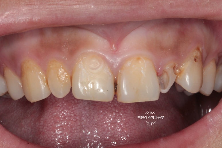 앞니에 잇몸염증과 충치가 심해요. 앞니 지르코니아 크라운 성공 후기. 치료과정/치료기간/비용/전후비교. 관련 이미지 9