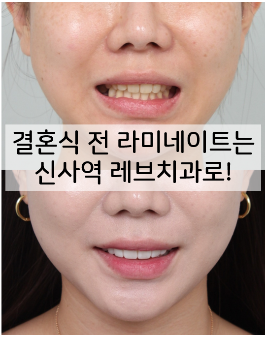 신사역 라미네이트. 결혼식 전 앞니 고민, 얇은 세라믹 레브네이트로 해결! 관련 이미지 1