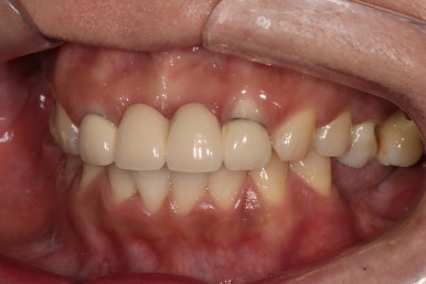 전세계 1위 스트라우만 임플란트를 사용한 어금니 기능회복과 앞니 지르코니아 크라운 증례. 관련 이미지 4