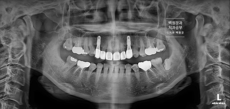 크라운 앞니 충치로 냄새가 나요 - 최소한의 임플란트와 씌우는 치료. 치료과정/기간/비용. 관련 이미지 17