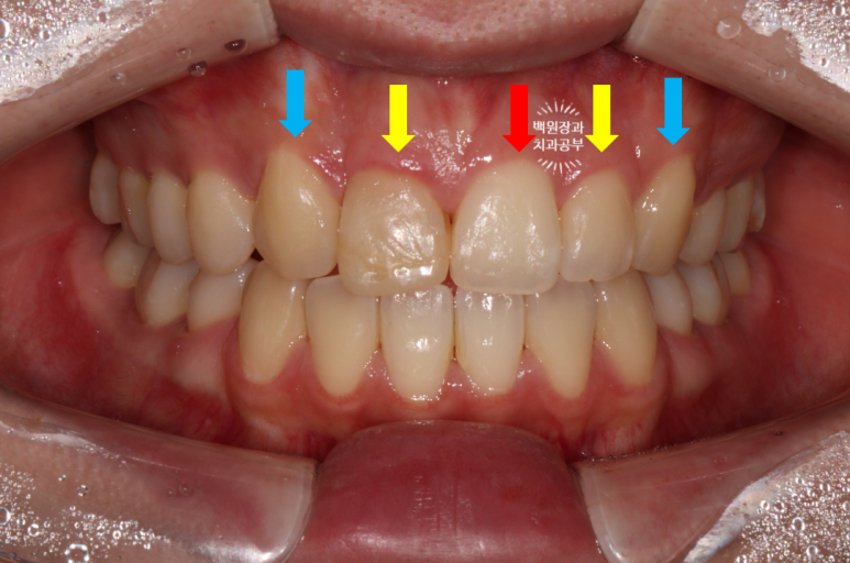잇몸 성형과 치아미백 그리고 지르코니아 20대 앞니 크라운 치료. 치료과정/기간/비용. 관련 이미지 3