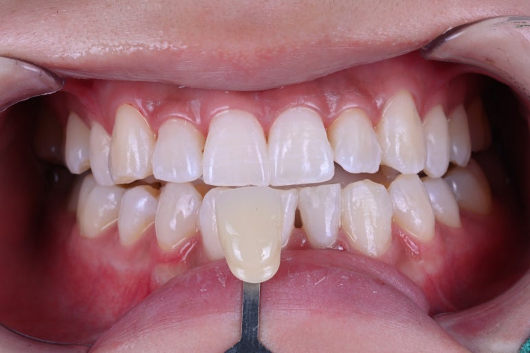 강남 치아미백 성지 레브치과. 가격/비용/부작용/전후사진. 관련 이미지 14