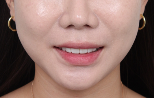 신사역 라미네이트. 결혼식 전 앞니 고민, 얇은 세라믹 레브네이트로 해결! 관련 이미지 22