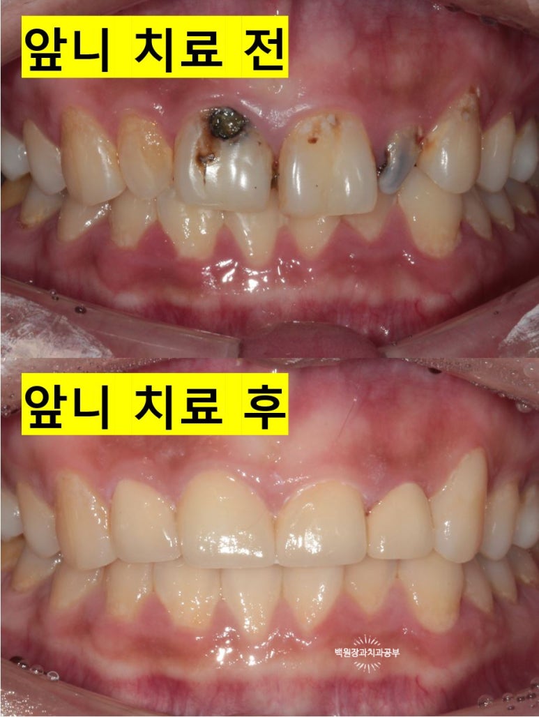 앞니에 잇몸염증과 충치가 심해요. 앞니 지르코니아 크라운 성공 후기. 치료과정/치료기간/비용/전후비교. 관련 이미지 21
