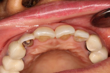 외과적 정출술 (surgical extrusion) - 치아를 살리는 마지막 방법. 치료과정/치료기간/비용/사진. 관련 이미지 11