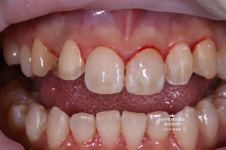 신사역 치과. 아나운서 면접 전 앞니 벌어진 공간을 라미네이트로만 해결할 수 있었던 사연.. 관련 이미지 15