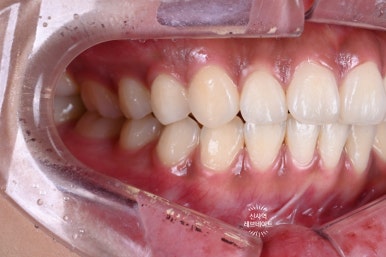What About Laminates at Sinsa Station? Rev Dental Clinic’s Revnate. image 4