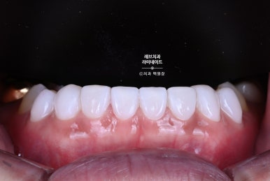아래앞니 라미네이트도 무삭제로 가능한가요? 레브네이트 베이직 가격/비용/후기/추천. 관련 이미지 15