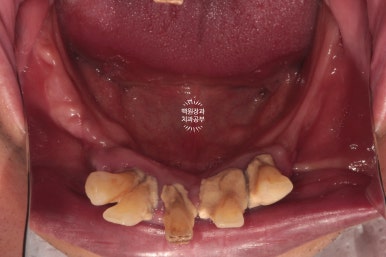 만성치주염으로 인해 아주 좁아진 잇몸뼈에 광범위한 뼈이식 + 전체임플란트. 신사 레브치과. 관련 이미지 8