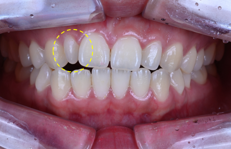 왜소치 라미네이트. 열심히 교정치료 받은 나를 위한 선물. 비용/과정/후기. 관련 이미지 3