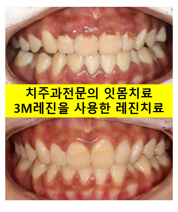 잇몸치료와 앞니 레진치료. 3년이 지난 모습 궁금하지 않으신가요? 3M 레진쓰는 치과. 후기/시간/과정/비용. 관련 이미지 1