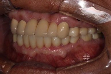 뿌리만 남은 앞니, 어금니가 없어 교합이 무너진 증례. 흡연자의 전체 오스템BA임플란트 재건증례. 치료과정/치료기간/비용/후기. 관련 이미지 26