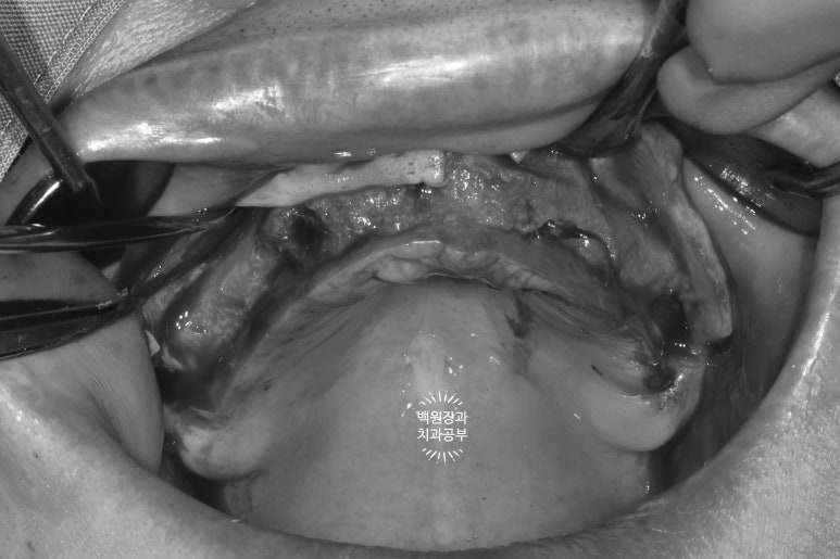 만성치주염으로 인해 아주 좁아진 잇몸뼈에 광범위한 뼈이식 + 전체임플란트. 신사 레브치과. 관련 이미지 21