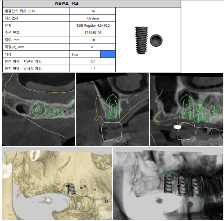 잇몸 염증 고름이 심했던 부위 - 만성치주염 진단하고 임플란트로 깔끔하게 치료! 신사역 치과 관련 이미지 15