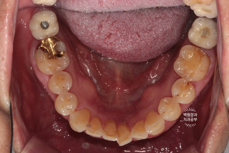 어금니 보철물이 떨어졌어요. 골드인레이 탈락 후 지르코니아 크라운으로 치료. 충치치료과정/치료기간/비용/후기. 관련 이미지 2