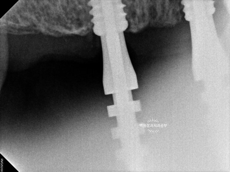 오스템임플란트 네비게이션 전체 임플란트 치료일기. 치료과정/치료기간/비용/솔직후기. 관련 이미지 11