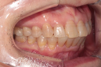 삐뚤어진 앞니를 8개월만에 가지런하게 만드는 50대 성인부분교정. 신사역 교정치과. 치료과정/기간/비용. 관련 이미지 19