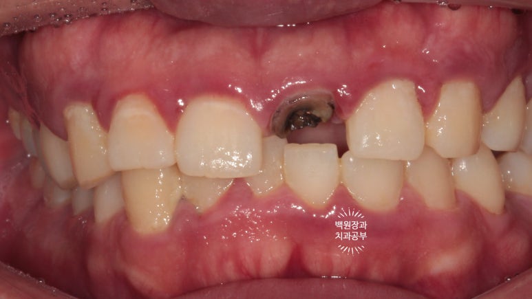 앞니 머리가 기둥째 부러졌어요. 발치 동시 뼈이식 오스템 BA 임플란트. 치료과정/치료기간/비용/후기. 압구정 치과. 관련 이미지 18