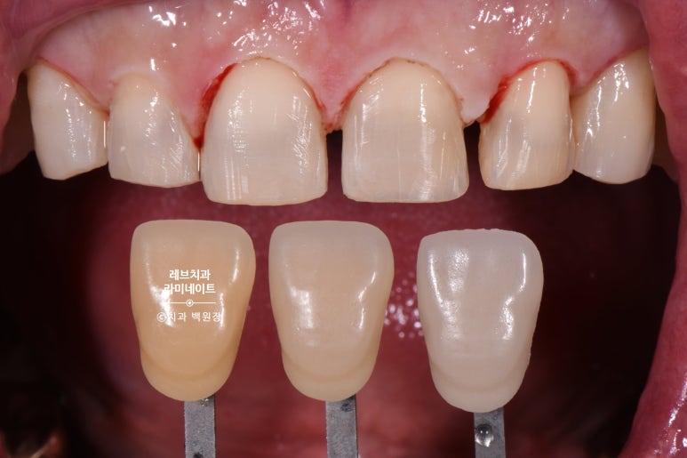 신사역 무삭제 라미네이트 : 레브네이트 내츄럴 최소삭제 비니어. 50대 앞니 벌어짐 비용/후기/얼굴사진. 관련 이미지 8