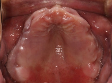 만성치주염으로 인해 아주 좁아진 잇몸뼈에 광범위한 뼈이식 + 전체임플란트. 신사 레브치과. 관련 이미지 10