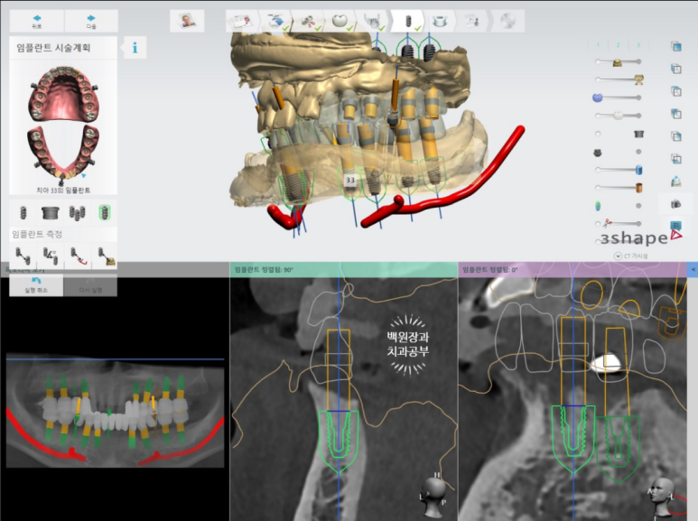 임플란트장인의 마음으로 8개월간 전체임플란트 완성. 치주과 전문의. 관련 이미지 8