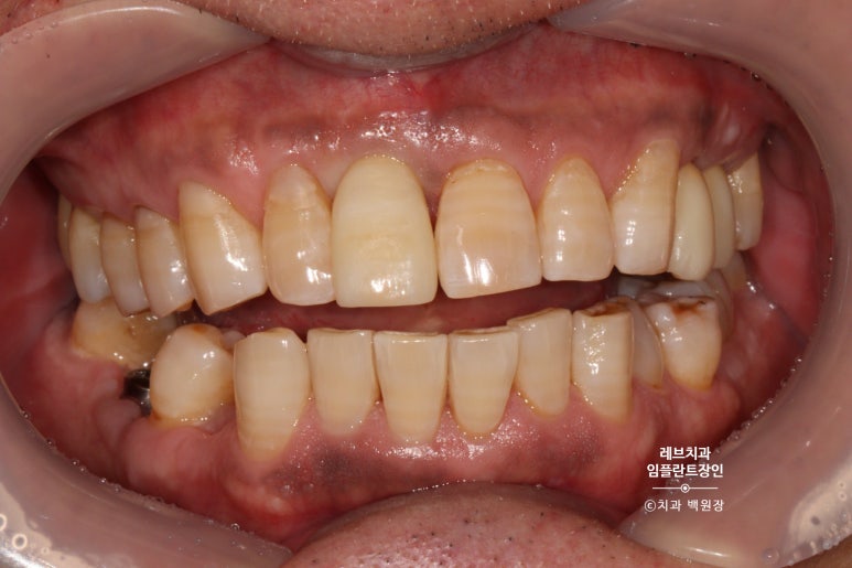 앞니 부러짐? 뽑고 바로 임플란트 + 뼈이식. 앞니 흔들림? 뽑고 1달 기다리고 임플란트 + 뼈이식. 신사역 치과 후기/비용/과정. 관련 이미지 9