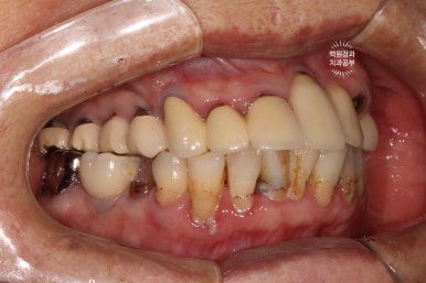 스트라우만 임플란트로 이뽑고 바로심는치과 - 믿고 사용하는 세계 1위 스위스 임플란트 회사. 관련 이미지 5