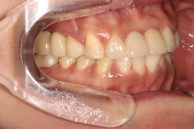 전세계 1위 스트라우만 임플란트를 사용한 어금니 기능회복과 앞니 지르코니아 크라운 증례. 관련 이미지 25