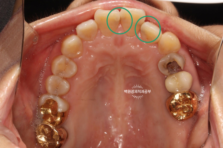 앞니레진치료 할 줄 모르는 치과의사는 없지만, 좋은 레진으로 치료하는 치과의사는 잘 없습니다. 관련 이미지 16