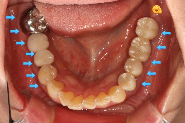 어금니 임플란트 주변 잇몸이식수술 - 저는 해야한다고 생각합니다. (feat. 대한치과의사협회 논문 + 치주과전문) 관련 이미지 26
