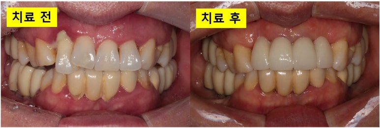 앞니가 풍치로 흔들거려요. 심한 치주염인데 임플란트 가능할까요? 치료과정/치료기간/비용/성공후기. 신금호역 치과 추천. 관련 이미지 36