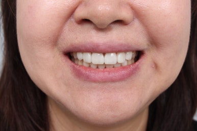 레브네이트 엑스퍼트 - 앞니 무삭제 라미네이트. 40대 벌어진 앞니에 변색된 레진은 이제 그만! 압구정 치과 추천 전후/비용. 관련 이미지 20