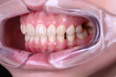 신사역 라미네이트. 결혼식 전 앞니 고민, 얇은 세라믹 레브네이트로 해결! 관련 이미지 5