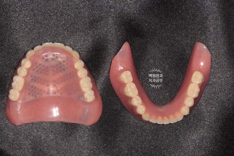 임플란트틀니 - 오버덴쳐. 오스템BA임플란트 이용한 최고의 가성비 치료. 치료과정/치료기간/비용/후기. 관련 이미지 14