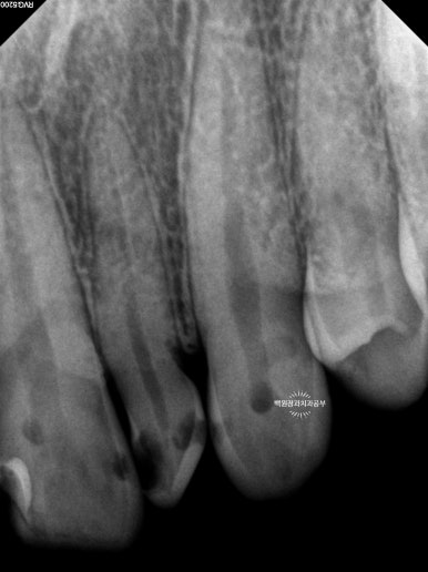 앞니에 잇몸염증과 충치가 심해요. 앞니 지르코니아 크라운 성공 후기. 치료과정/치료기간/비용/전후비교. 관련 이미지 7