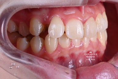 신사역 치과. 아나운서 면접 전 앞니 벌어진 공간을 라미네이트로만 해결할 수 있었던 사연.. 관련 이미지 3