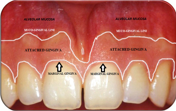 어금니 임플란트 주변 잇몸이식수술 - 저는 해야한다고 생각합니다. (feat. 대한치과의사협회 논문 + 치주과전문) 관련 이미지 4
