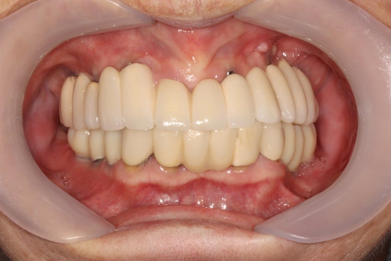부분틀니를 오래써서 어금니가 아플 때, 아래턱 양쪽 어금니 임플란트 잘하는 강남임플란트치과 관련 이미지 28
