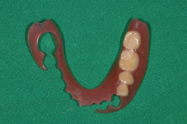 어금니 임플란트 주변 잇몸이식수술 - 저는 해야한다고 생각합니다. (feat. 대한치과의사협회 논문 + 치주과전문) 관련 이미지 9