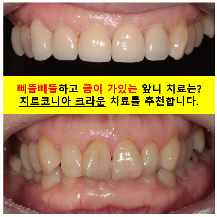 삐뚤빼뚤 앞니 세로 금  - 신경치료 없이 지르코니아 크라운으로. 상악동뼈이식술 임플란트. 관련 이미지 1