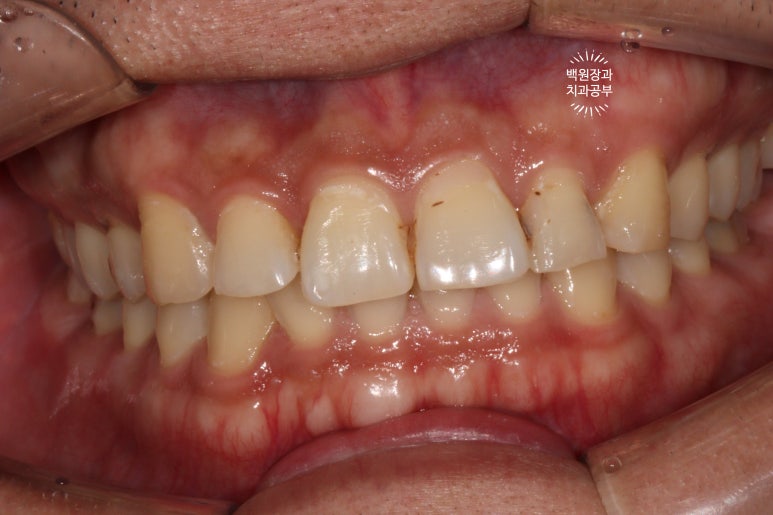 교정 유지장치 근처 앞니 옆면 충치 및 착색 간단히 3M 레진으로 치료. 치료과정/비용/후기. 과잉진료 없는 치과. 관련 이미지 3