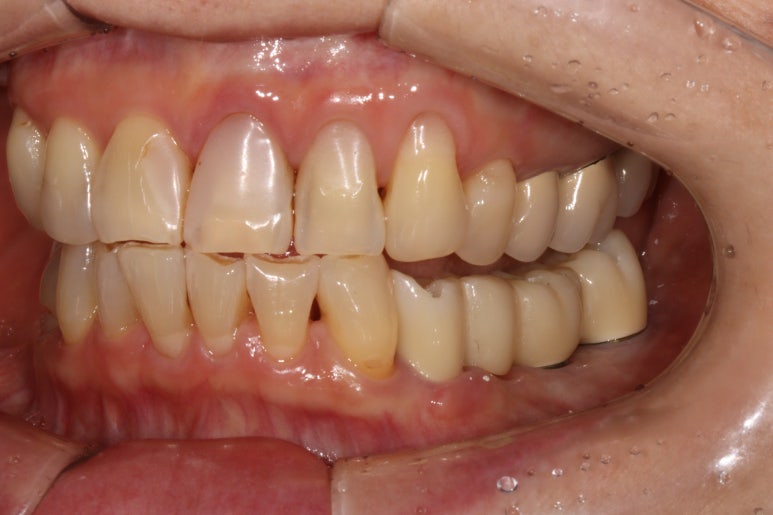 어금니 임플란트 주변 잇몸이식수술 - 저는 해야한다고 생각합니다. (feat. 대한치과의사협회 논문 + 치주과전문) 관련 이미지 24