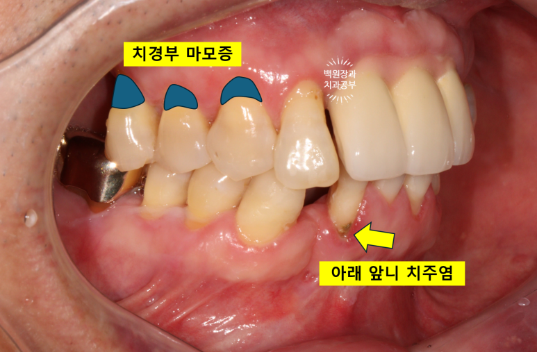 치주염으로 흔들리는 앞니부터 어금니 뼈이식 임플란트까지 - 5개월간 정성스러운 치료 과정. 관련 이미지 7