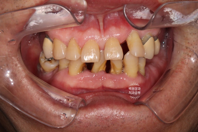 임플란트장인의 마음으로 8개월간 전체임플란트 완성. 치주과 전문의. 관련 이미지 3