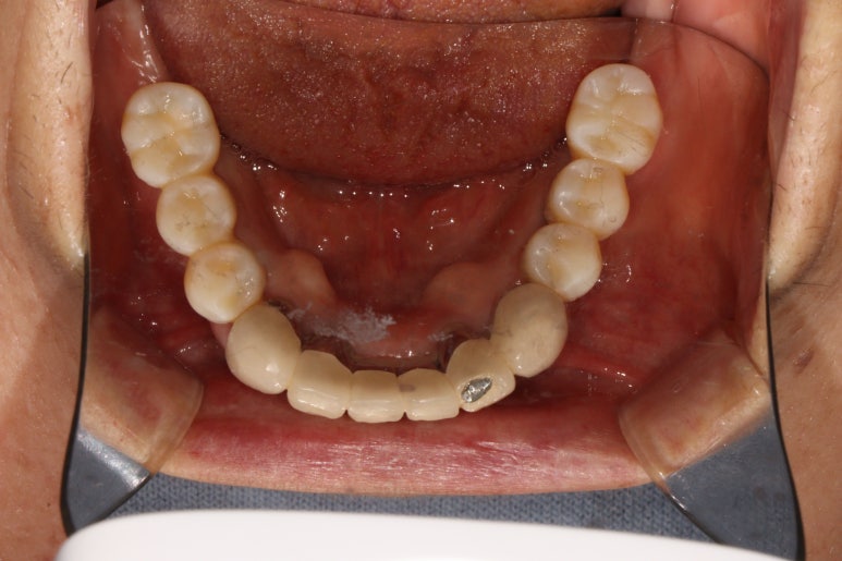 부분틀니를 오래써서 어금니가 아플 때, 아래턱 양쪽 어금니 임플란트 잘하는 강남임플란트치과 관련 이미지 21