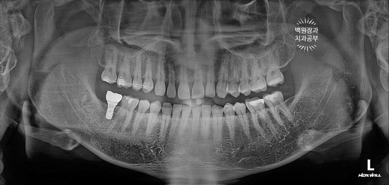 아래 어금니가 없어 위 어금니가 내려왔어요. 부분 교정을 곁들인 스트라우만 임플란트 수술. 억울한 신경치료를 피해보자. 치료과정/치료기간/비용/후기. 관련 이미지 12