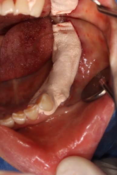 어금니 임플란트 주변 잇몸이식수술 - 저는 해야한다고 생각합니다. (feat. 대한치과의사협회 논문 + 치주과전문) 관련 이미지 21