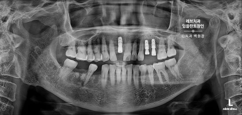 앞니 부러짐? 뽑고 바로 임플란트 + 뼈이식. 앞니 흔들림? 뽑고 1달 기다리고 임플란트 + 뼈이식. 신사역 치과 후기/비용/과정. 관련 이미지 6